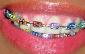 aparelhos ortodonticos