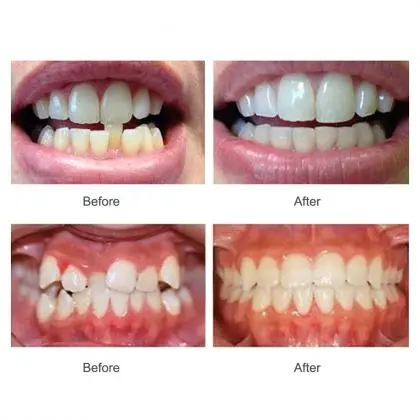 Aparelho Invisível  - SouSmile