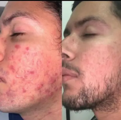 Enfrentando a acne de frente