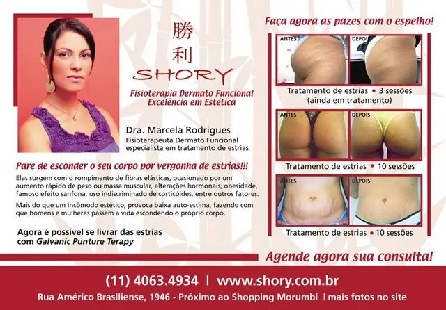 Solução para Estrias - clínica Shory S.P