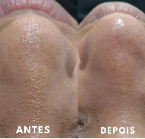 Duas limpezas de pele com extração de cravos apenas 3 de 37, 00 no cartão!!