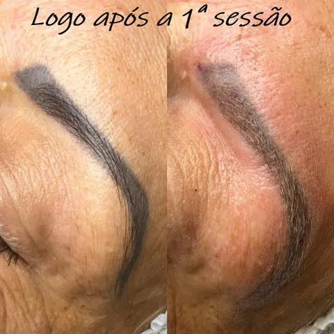 Despigmentação de tatuagem e micropigmentação com laser