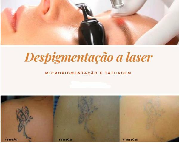 Despigmentação de tatuagem e micropigmentação com laser