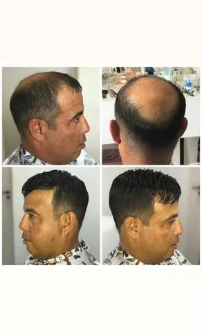 Prótese Capilar
