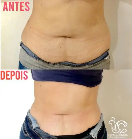 LIPO ENZIMÁTICA PERCA MEDIDAS promoção de carnaval essa semana