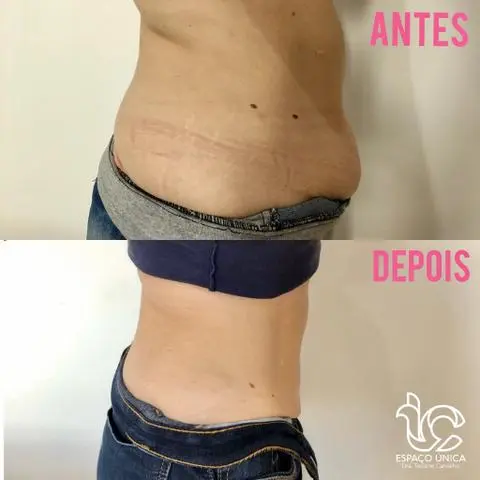LIPO ENZIMÁTICA PERCA MEDIDAS promoção de carnaval essa semana