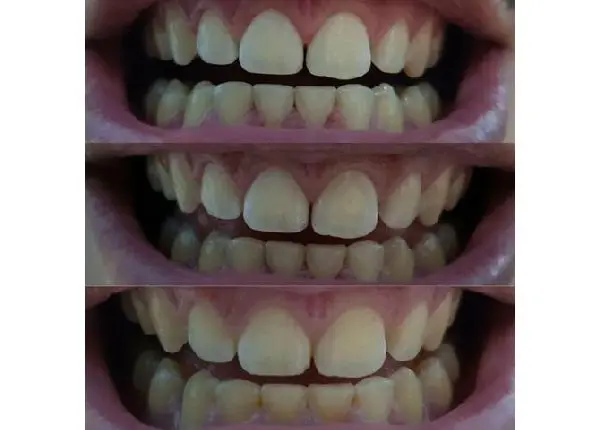 Gel dental de carvão ativo