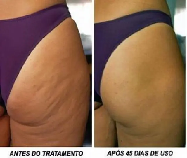 Creme para o tratamento de estrias, inclusive as brancas, e gel redutor com DMAE anticelulite BIO - MÉDICIN