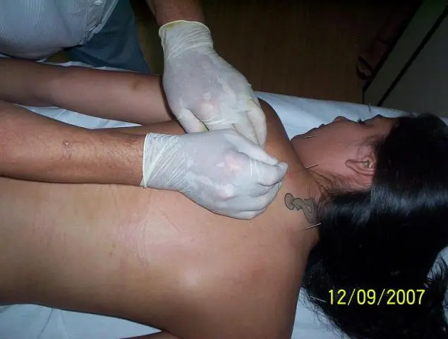 SHIATSU E ACUPUNTURA - TERAPIAS ALTERNATIVAS