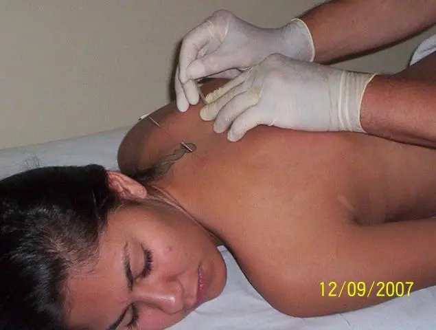 ACUPUNTURA CURA DEPRESSÃO