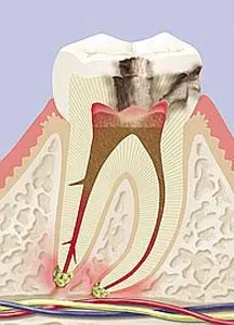Tratamento de Canal Campinas Dr Fábio Padoan Clinica Endodontia Campinas