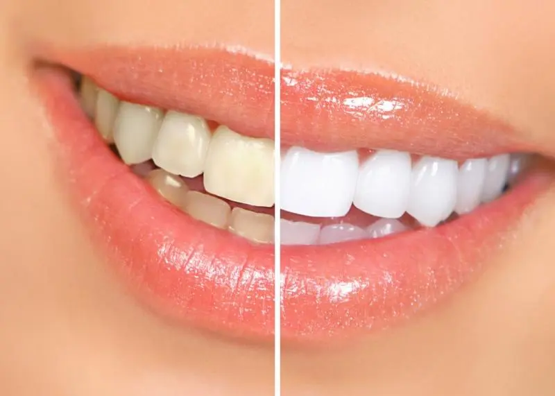 Clareamento Dental Curitiba